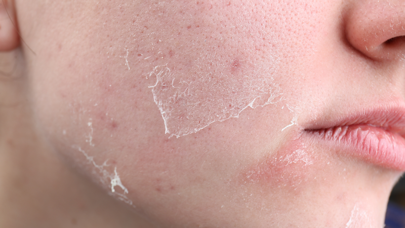Dùng retinol bị bong da trong bao lâu?