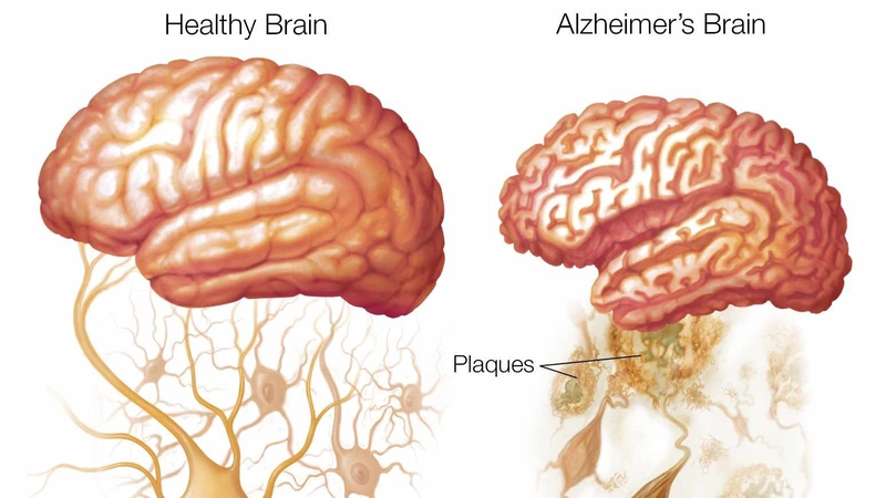 Đường làm trầm trọng thêm bệnh Alzheimer: Bạn có biết? 2