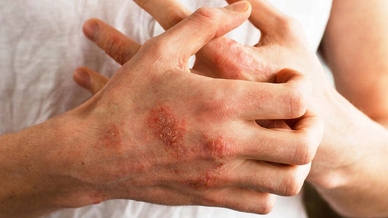 Eczema main: Nguyên nhân, triệu chứng và phương pháp điều trị 1