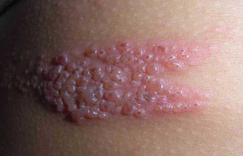 Eczema main: Nguyên nhân, triệu chứng và phương pháp điều trị 3