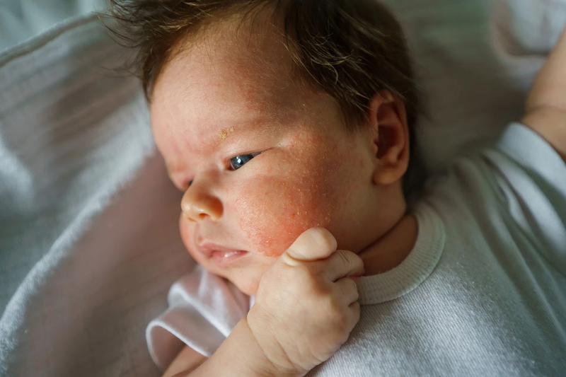 Em bé bị nổi mẩn đỏ trên mặt, nguyên nhân và cách xử trí 1