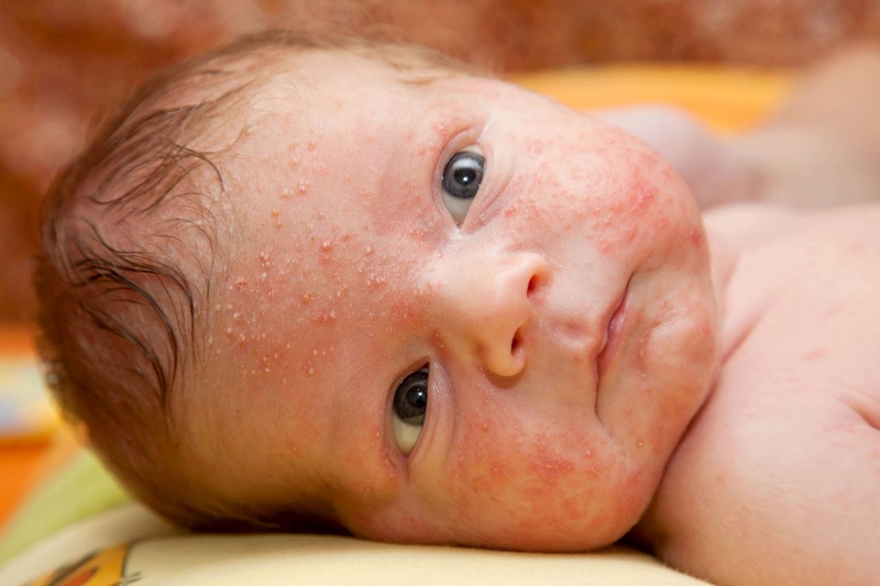 Em bé bị nổi mẩn đỏ trên mặt, nguyên nhân và cách xử trí 2