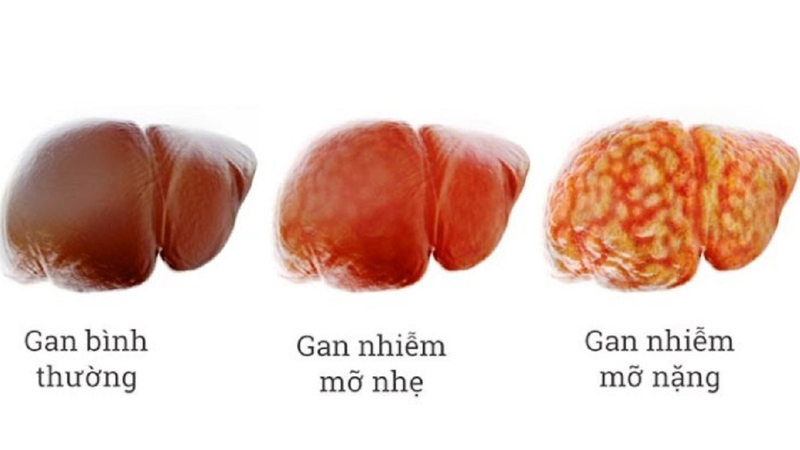 Gan Nhiễm Mỡ Độ 3 Nên Ăn Gì: Bí Quyết Thực Đơn Lành Mạnh