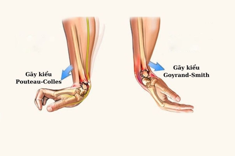 Gãy Smith: Nguyên nhân, Triệu chứng và Cách Điều Trị Hiệu Quả