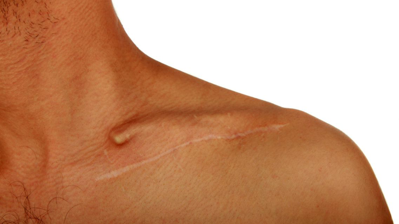 Gãy xương đòn có đá bóng được không? Khi nào có thể trở lại đá bóng? 2