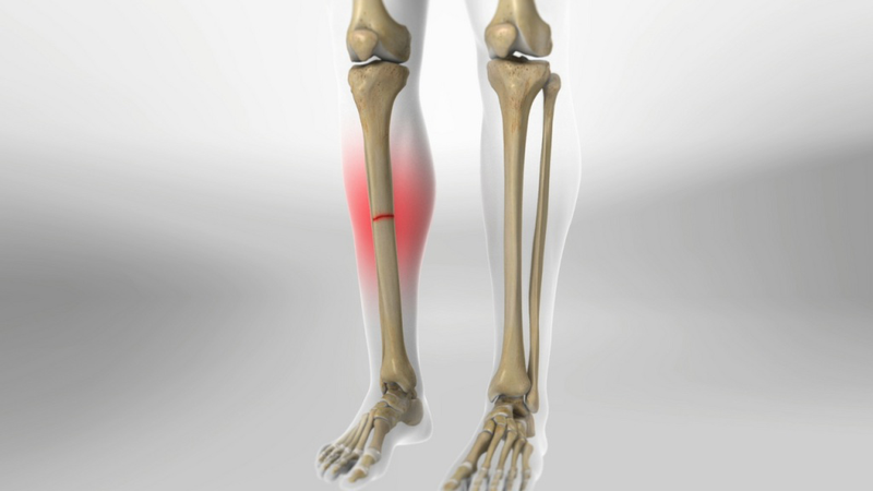 Gãy xương ống chân bao lâu mới lành và cần lưu ý những gì? 3