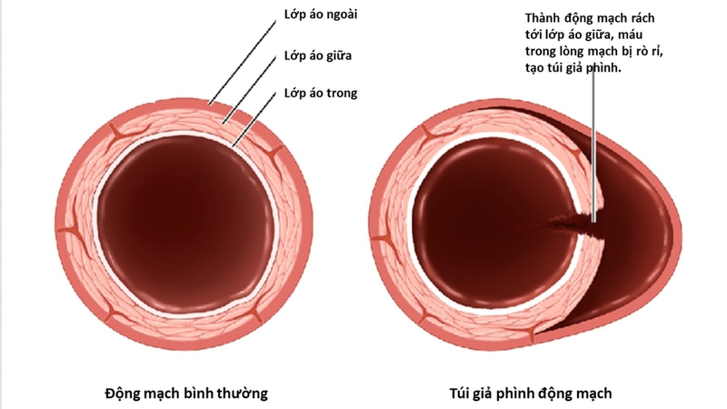 Giả phình động mạch do thông tim 1