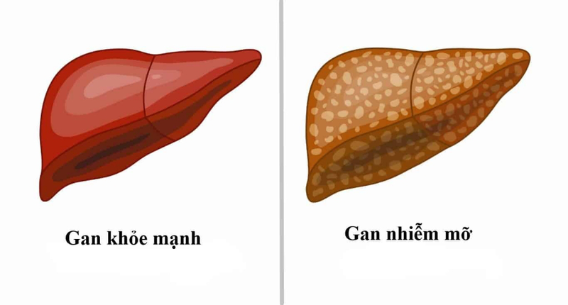 Giải đáp thắc mắc: Bị bệnh gan nhiễm mỡ độ 3 sống được bao lâu? 2