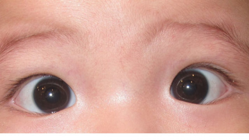 [Giải đáp thắc mắc] Lác mắt bẩm sinh có chữa được không 1