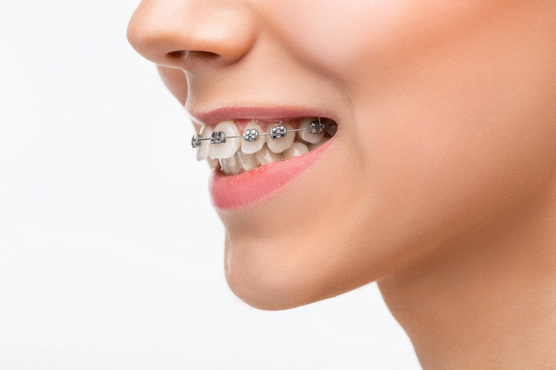 Giai đoạn đóng khoảng trong niềng răng 1