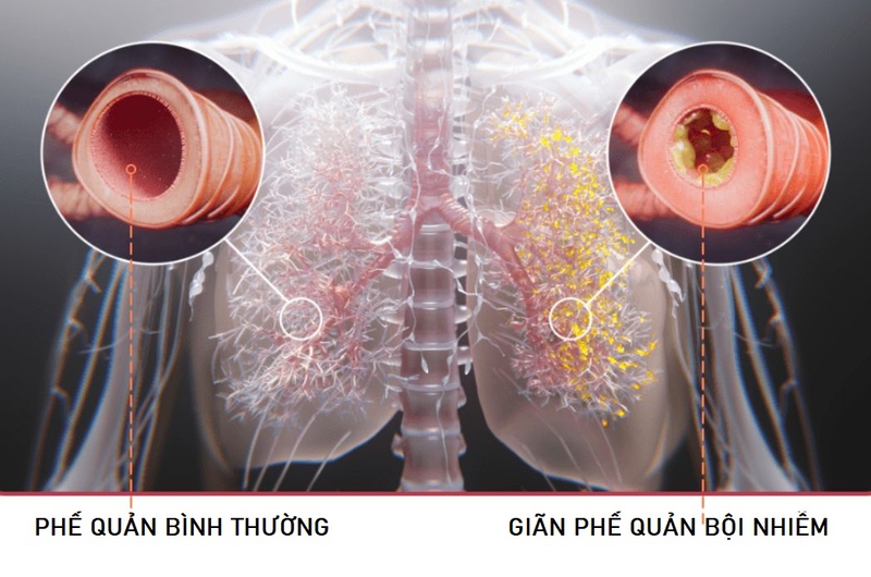 Giãn phế quản bội nhiễm: Nguyên nhân, triệu chứng, cách điều trị 1