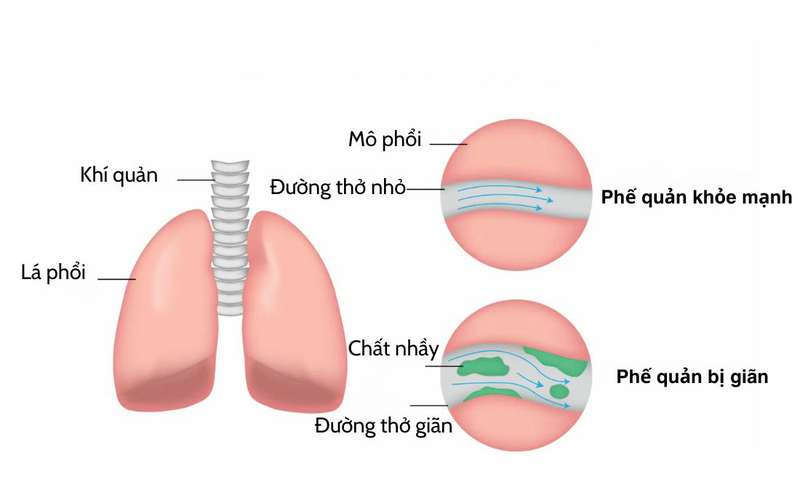 Giãn phế quản sống được bao lâu? Cách kéo dài tuổi thọ cho người bệnh 1