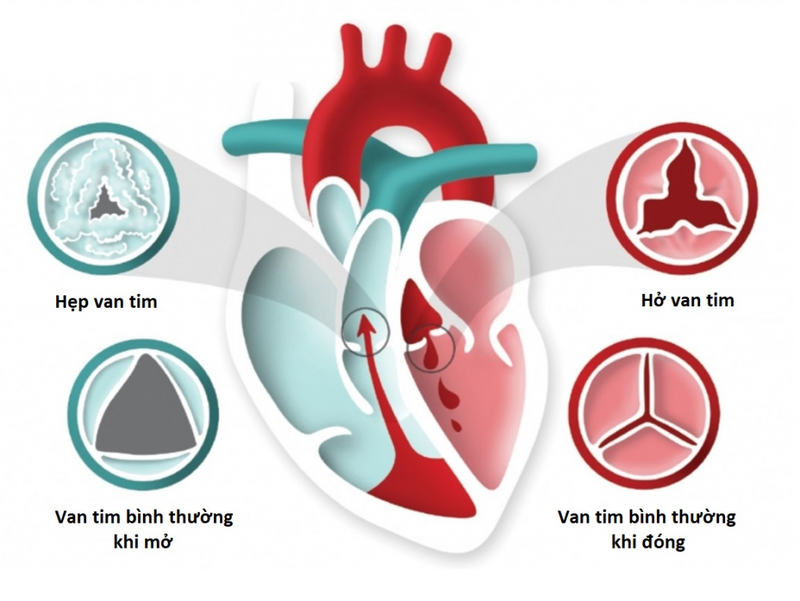 Góc giải đáp: Bệnh hở van tim kiêng ăn gì để tốt cho sức khỏe tim mạch? 1
