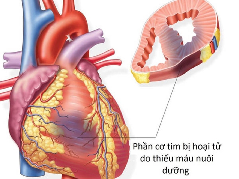 Góc giải đáp thắc mắc: Bệnh nhồi máu cơ tim có nguy hiểm không? 1