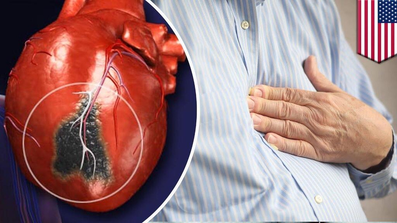 Góc giải đáp thắc mắc: Bệnh nhồi máu cơ tim có nguy hiểm không? 4