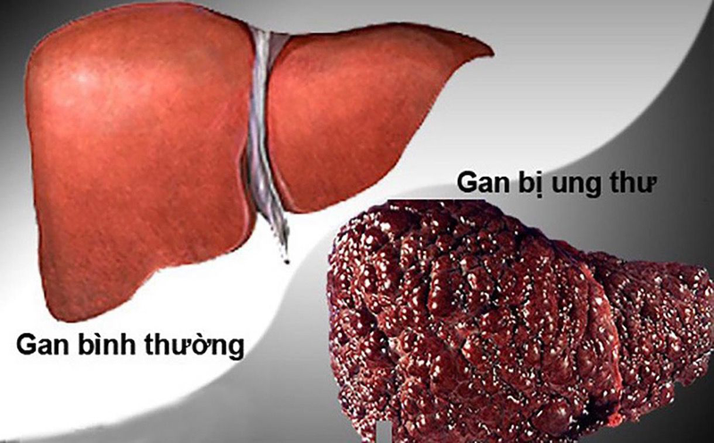 Viêm Gan B Có Di Truyền Không? Sự Thật Bạn Cần Biết