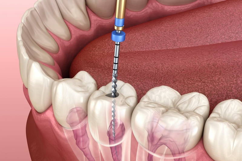 Góc thắc mắc: Răng đang đau có lấy tủy được không? 02