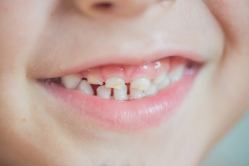 Hai răng cửa của bé bị hở: Nguyên nhân, tác hại và cách cải thiện 1