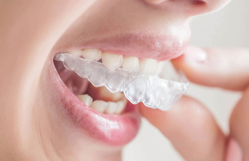 Rửa Hàm Bằng Nước Sạch Hoặc Dung Dịch Chuyên Dụng