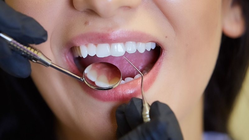 Hàn răng sâu xong bị đau nhức​ phải làm sao? 3