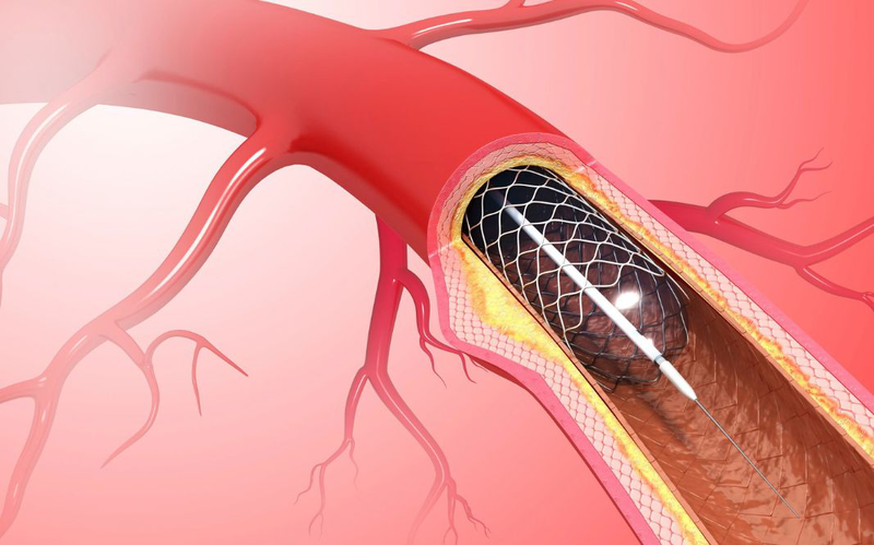 Hẹp mạch vành 60 là mức độ nặng hay nhẹ? Cần đặt stent chưa 2
