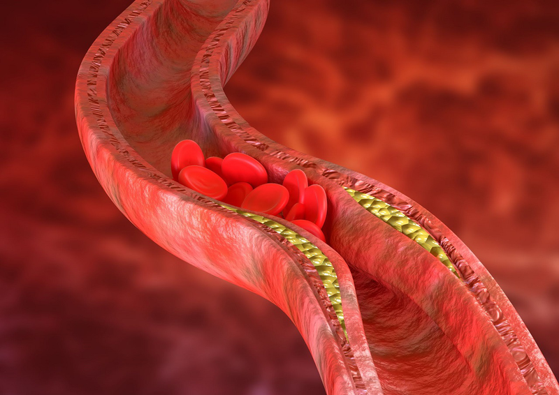 Hẹp mạch vành: Triệu chứng, phân loại và mức độ nguy hiểm 2