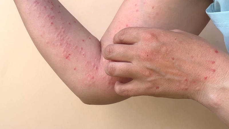 Muốn hết sốt nổi mẩn đỏ ở người lớn​, áp dụng ngay cách này 3