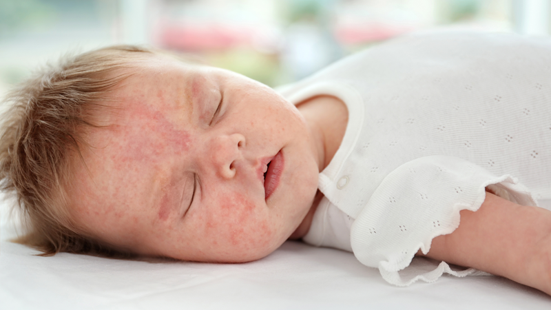 Hình ảnh bé bị dị ứng đạm sữa bò và cách khắc phục tình trạng này 3