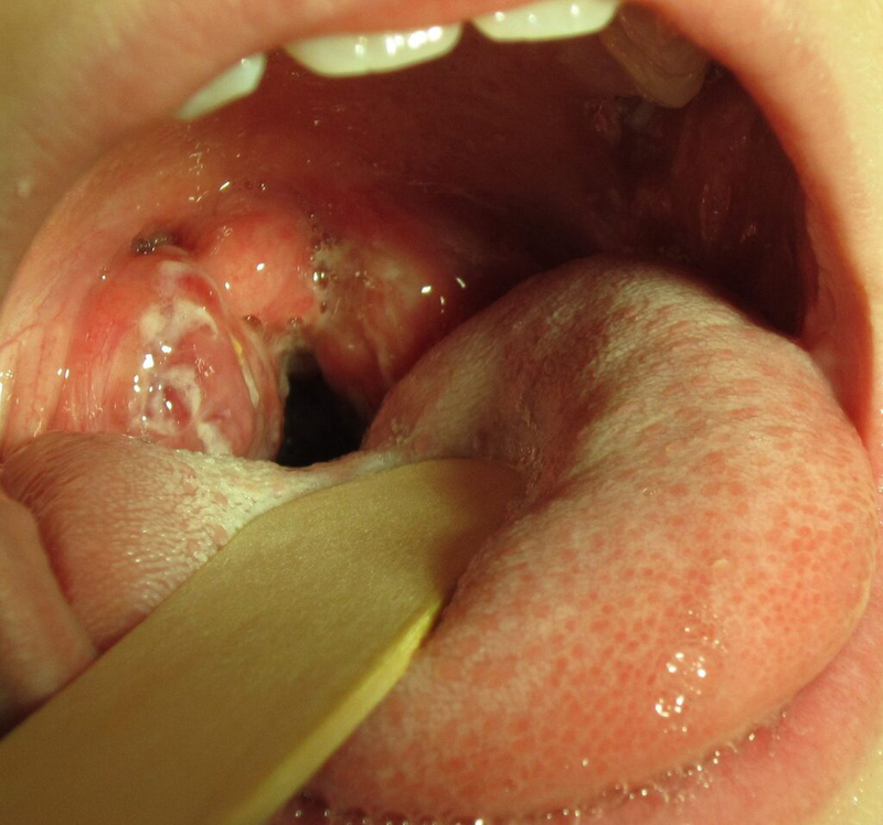 Hình ảnh bệnh Chlamydia: Những thông tin quan trọng cần biết 4