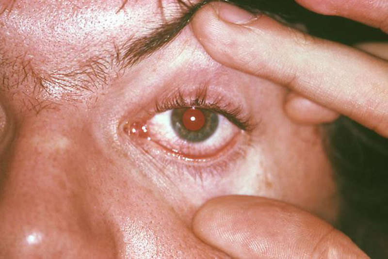 Hình ảnh bệnh Chlamydia: Những thông tin quan trọng cần biết 5