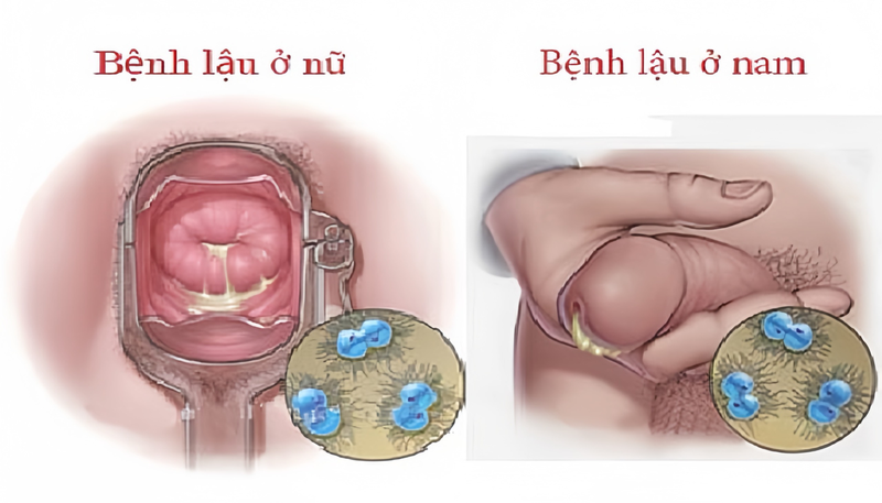 Hình ảnh bệnh lậu: Dấu hiệu nhận biết và các biến chứng khác 3