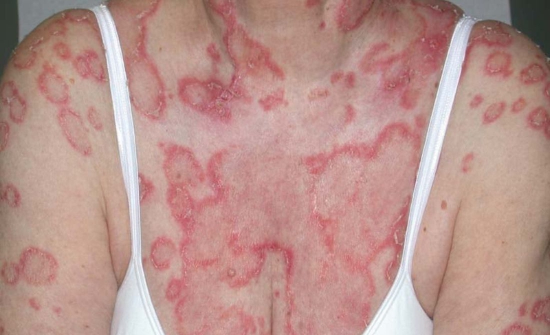 Hình ảnh bệnh lupus ban đỏ​ biểu hiện trên da như thế nào 1