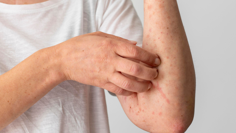 Khi nghi ngờ mình có các dấu hiệu hoặc hình ảnh bệnh lupus ban đỏ, bạn cần đến khám bác sĩ chuyên khoa sớm