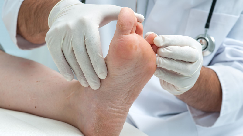 Hình ảnh bệnh nấm tổ đỉa từng loại dễ nhận biết và điều trị 5