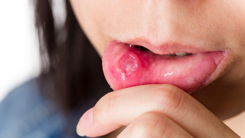 Nhận biết hình ảnh nhiệt miệng qua từng giai đoạn để chăm sóc đúng cách2