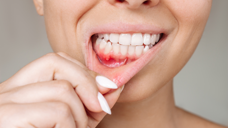 Nhận biết hình ảnh nhiệt miệng qua từng giai đoạn để chăm sóc đúng cách7