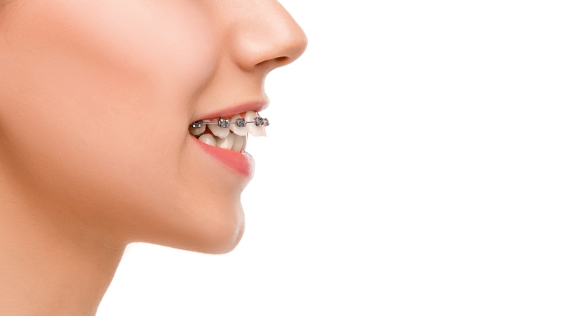 Hình ảnh răng hô nhẹ​ cùng giải pháp cải thiện 3