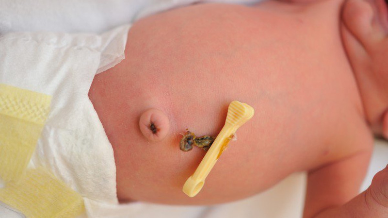 Hình ảnh rốn trẻ sơ sinh bình thường và cách chăm sóc rốn sau rụng 2