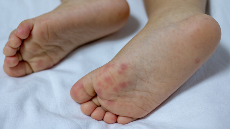 Có các nốt ban đỏ hoặc mụn nước nhỏ, không tụ mủ, rải rác, thường không gây đau nhiều