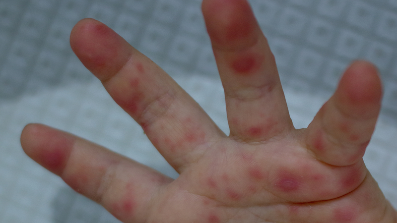 Bệnh có khả năng tiến triển nhanh sang các cấp độ nặng hơn, đặc biệt trong 3 - 5 ngày đầu khởi phát