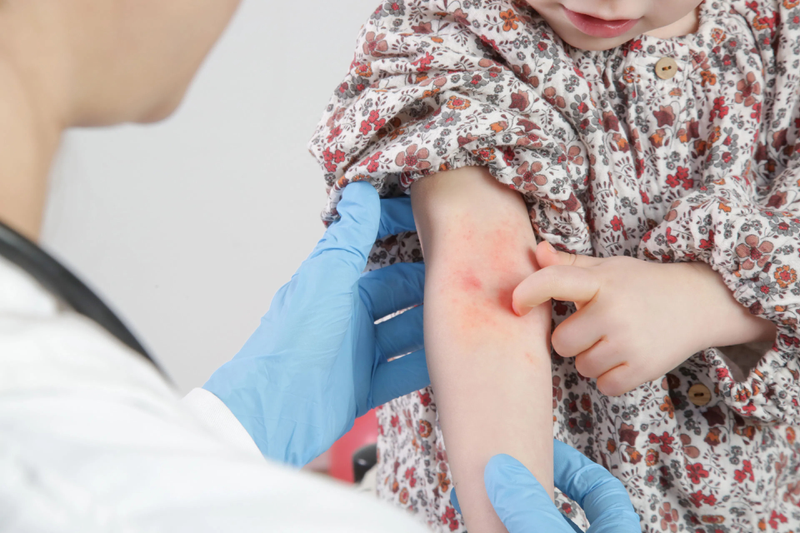 Hình ảnh viêm da cơ địa ở trẻ em từng giai đoạn giúp bạn hiểu hơn về căn bệnh 3