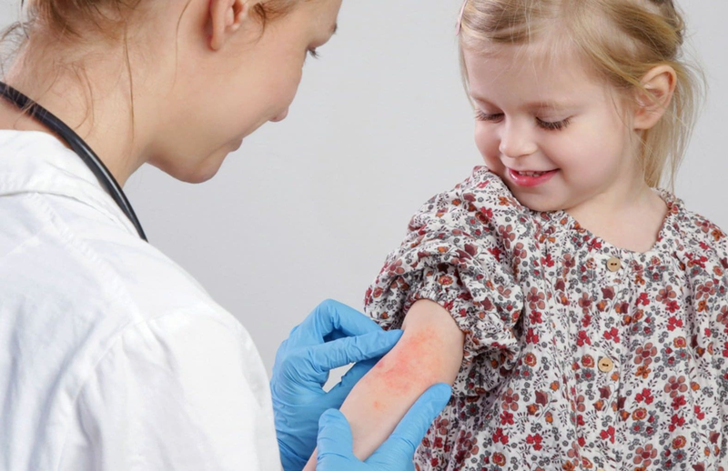 Hình ảnh viêm da cơ địa ở trẻ em từng giai đoạn giúp bạn hiểu hơn về căn bệnh 5