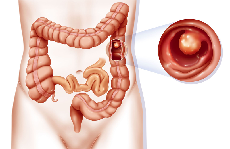 Ứng dụng và cách chụp hình ảnh viêm đại tràng 1