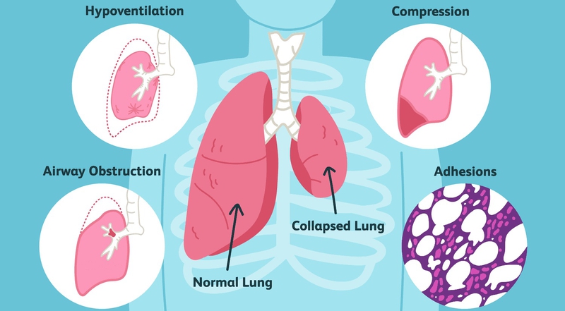 Hình thể ngoài, cấu trúc của nhu mô phổi và các bệnh về phổi thường gặp 5