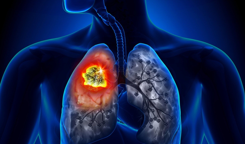 Hình thể ngoài, cấu trúc của nhu mô phổi và các bệnh về phổi thường gặp 6