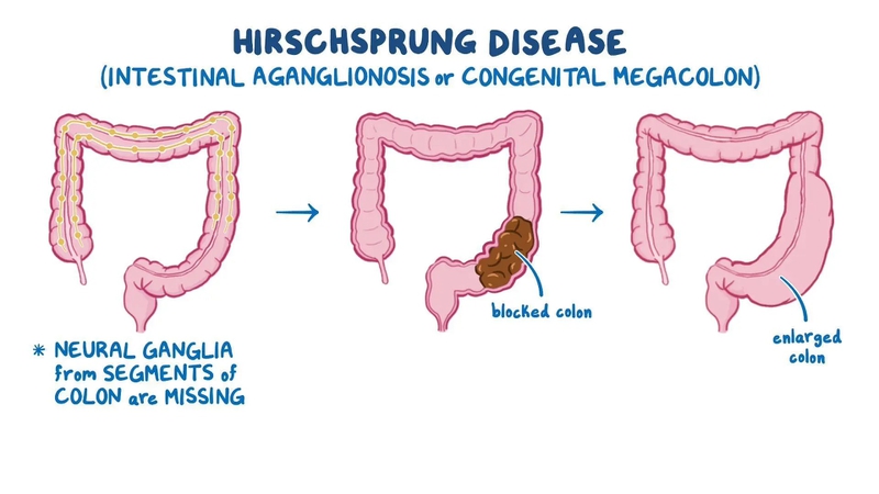 Tổng quan về bệnh hirschsprung 2