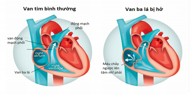 Các biến chứng nguy hiểm của hở van tim 3 lá 2/4 1