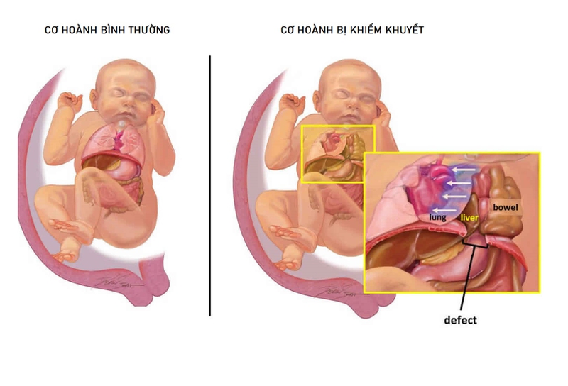 Hội chứng Fryns là gì? Nguyên nhân, triệu chứng, cách điều trị 1