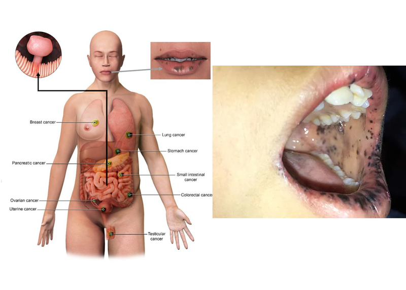 Giải đáp 5 câu hỏi thường gặp về hội chứng Peutz-Jegher 1