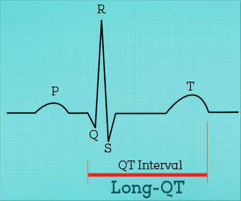 Hội chứng khoảng QT dài là gì? Nguyên nhân nào gây ra hội chứng khoảng QT dài? 1